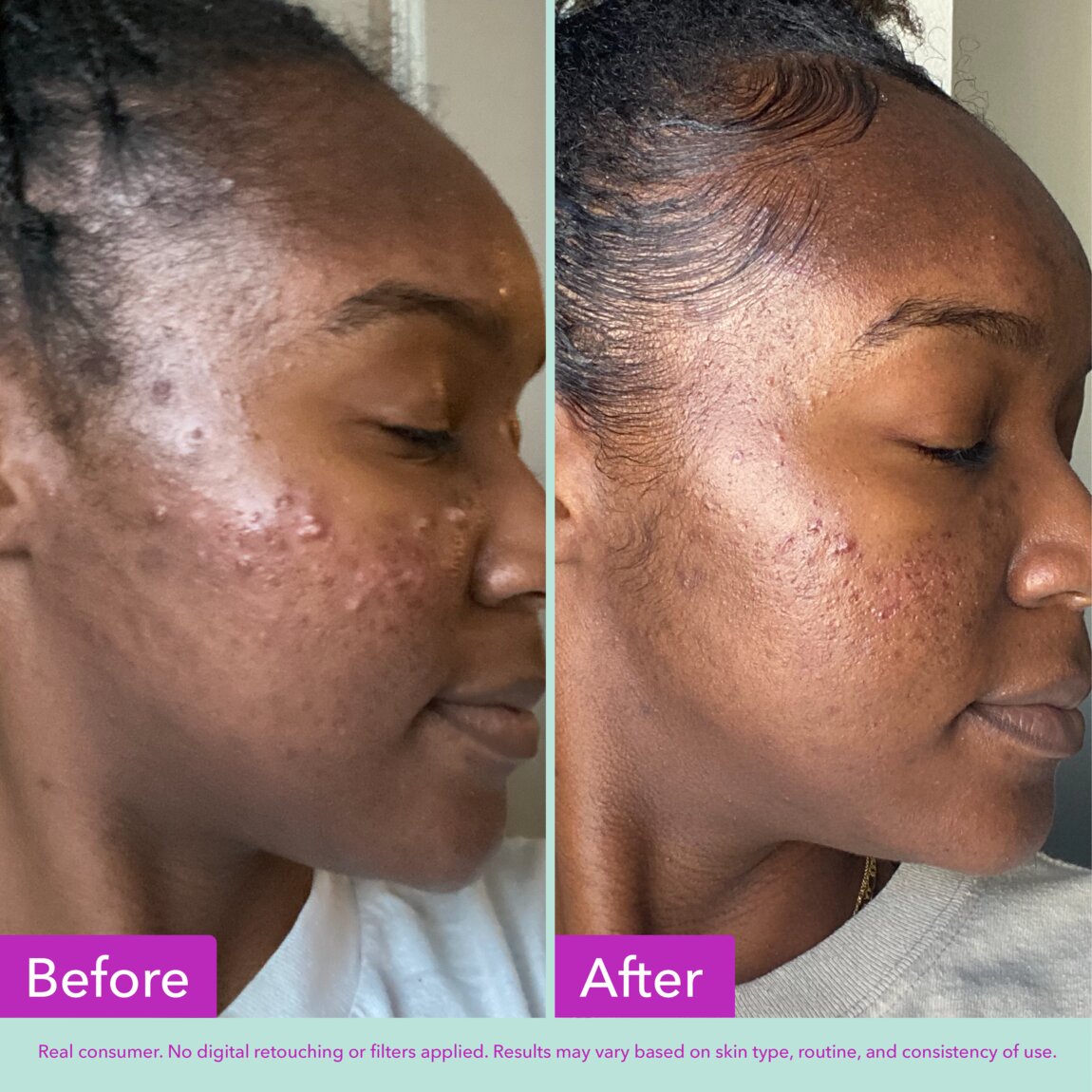 acne-foaming-cleanser-k6 zb_p.jpg